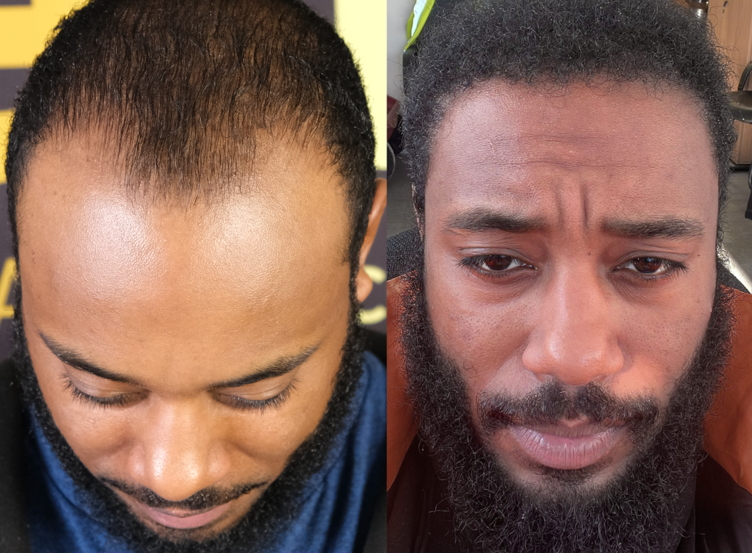 Hair Growth Serum Roller™