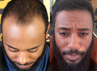 Hair Growth Serum Roller™