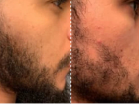 Hair Growth Serum Roller™