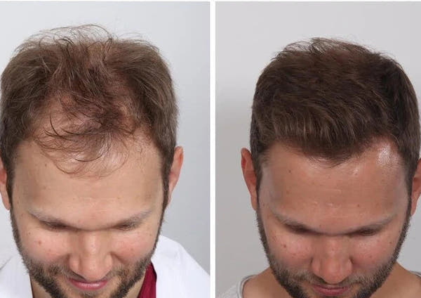 Hair Growth Serum Roller™